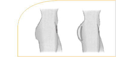 Gluteoplastia - Aumento de gluteos